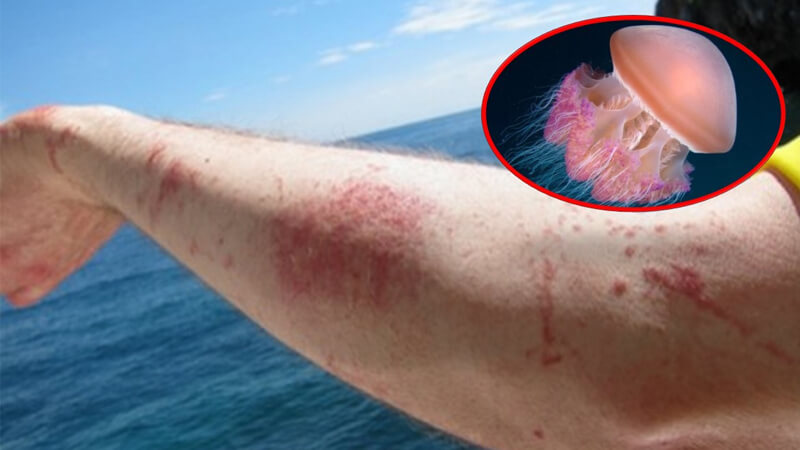 Cách xử lý khi bị sứa cắn, thích tắm biển phải biết điều này