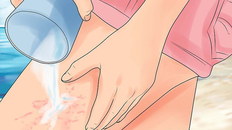 Rửa sạch vết thương khi bị sứa cắn
