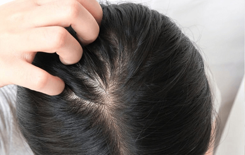 Tẩy tế bào chết da đầu có tác dụng loại bỏ vi khuẩn làm thông thoáng lỗ chân lông